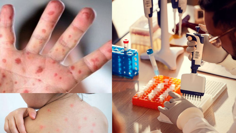 মহামারিতে রূপ নিতে পারে হাম, ১৯ দিনে উপসর্গ নিয়ে ৯৪ শিশুর মৃত্যু